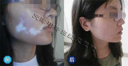 白癜風是怎樣引起的呢?