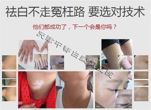 生活中白癜風(fēng)會不會遺傳呢?