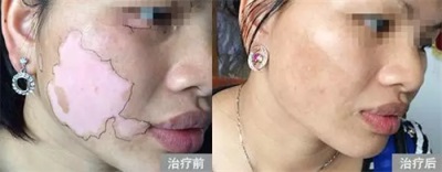 適合白癜風的飲食有哪些呢?